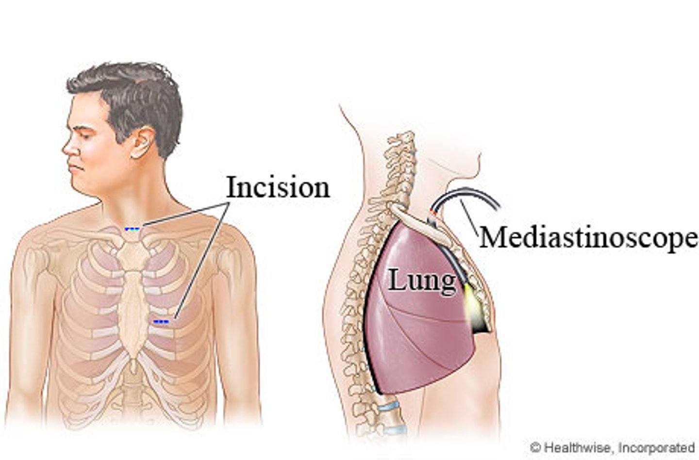 <p>Diagnostic procedure to obtain <strong>tracheobronchial lymph specimens</strong></p><p>- Small incision above suprasternal notch</p><p>- <strong>Superior mediastinum</strong> is explored</p><p>- Tuberculosis, sarcoidosis, lymphoma, lung cancer</p>