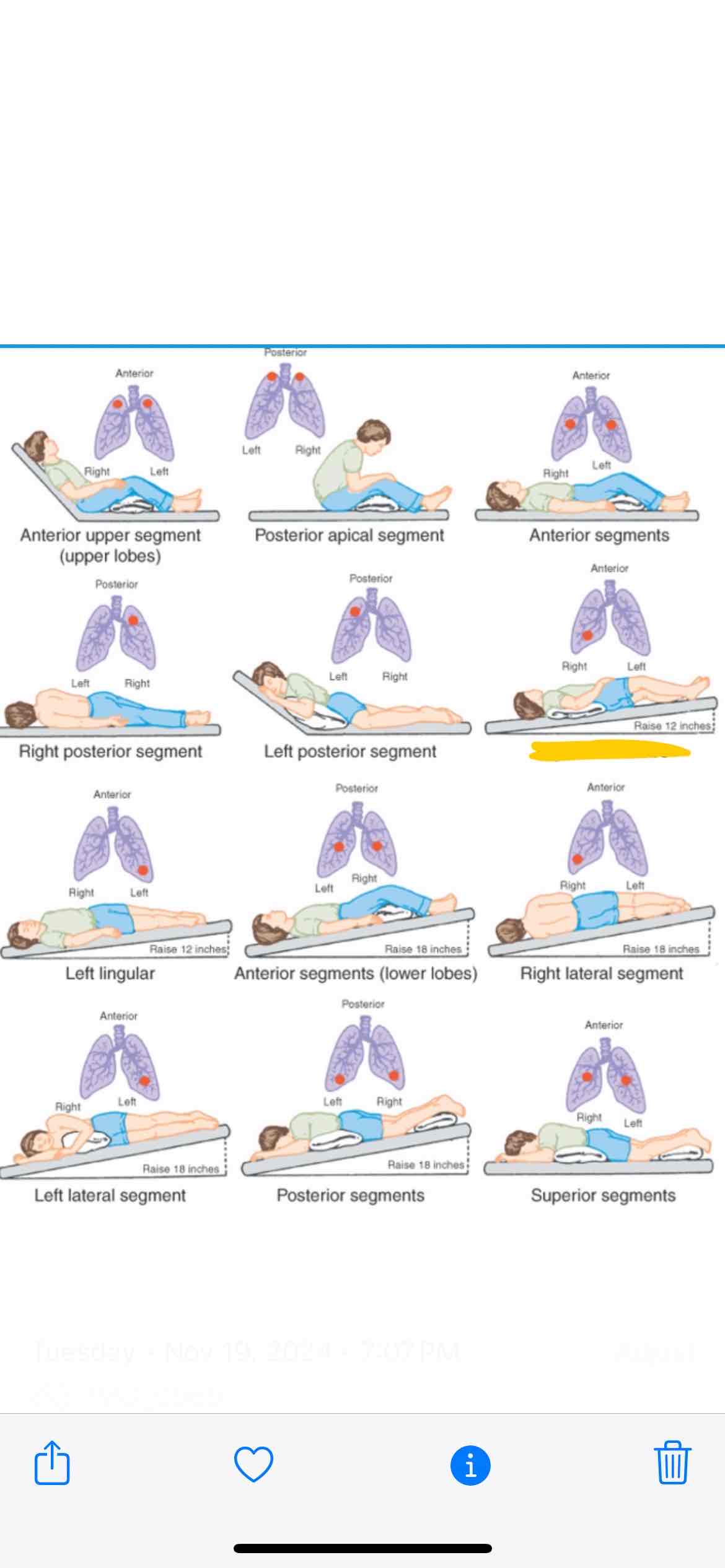 <p><span>Which lung segment does this position effect</span></p>