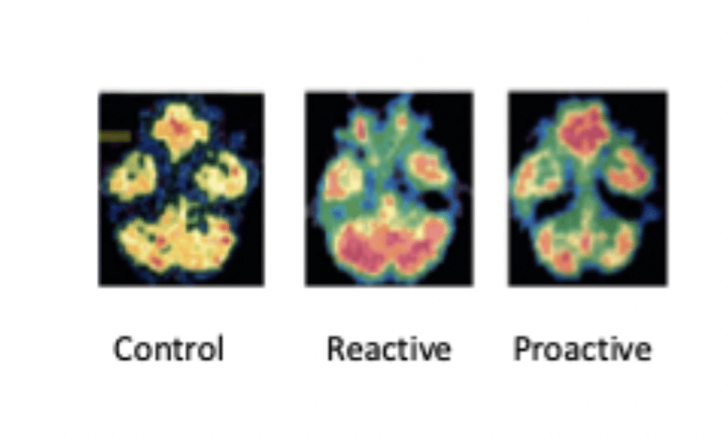 <p>- Raine et al. (1994), 22 murderers who pleading not guilty by reason of insanity were matched to controls </p><p>- PET brain scan done while doing attention task and found murders had less activation in prefrontal cortex</p><p>- replicated and extended in 1997, found less grey matter in cortical and subcortical regions </p><p>- in 1998 group divided into 15 proactive murders, 9 reactive and 41 controls found proactive murderers have more activity in pfc than reactive murders which enables them to control the limbic system better and act in more planned organised way </p>