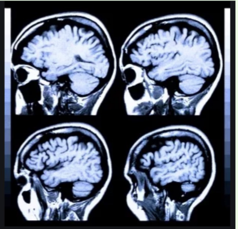 <p>It combines (with a computer) a series of x-ray photographs from different angles to create a composite representation of a slice through the brain or body</p>