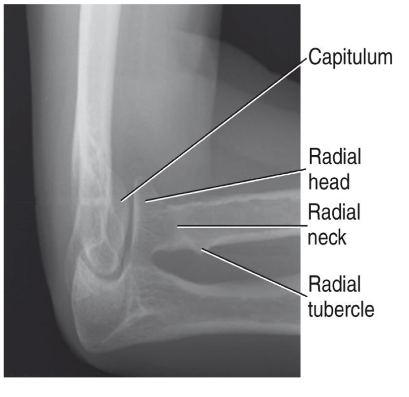 <p><span style="line-height: normal;"><span>• </span></span>Open joint space between radial head & capitulum</p><p class="p1"><span style="line-height: normal;"><span>• </span></span>Radial head, neck & tuberosity nearly free of superimposition</p><p class="p1"><span style="line-height: normal;"><span>• </span></span>Radial tuberosity facing posterior (indicating the hand is pronated)</p><p class="p1"><span style="line-height: normal;"><span>• </span></span>Humeral epicondyles will be distorted due to the CR angle</p>