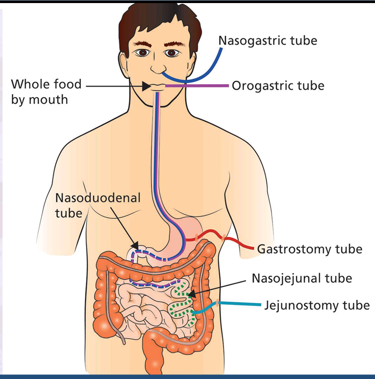 <p>What are the types of feeding tubes</p>