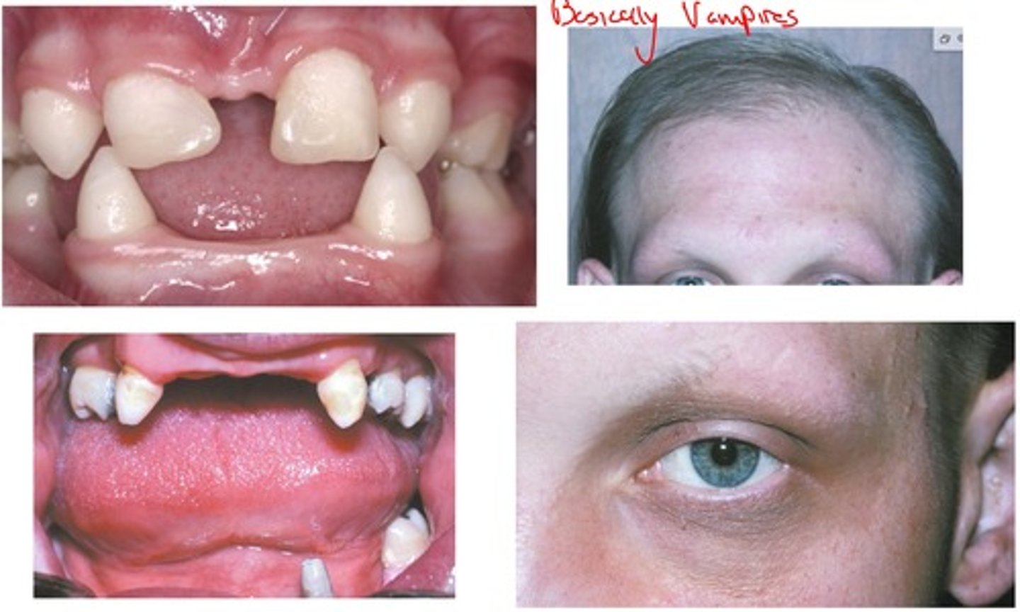 <p>-RARE inherited conditions in which 2 or more ectodermally derived anatomic structures fail to develop (skin, hair, nails, teeth, sweat glands)</p><p>-inherited in several genetic patterns</p>