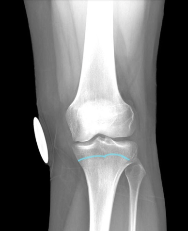 As bone growth slows, the cartilaginous
epiphyseal (growth) plate narrows and
eventually ossifies, leaving an
epiphyseal line