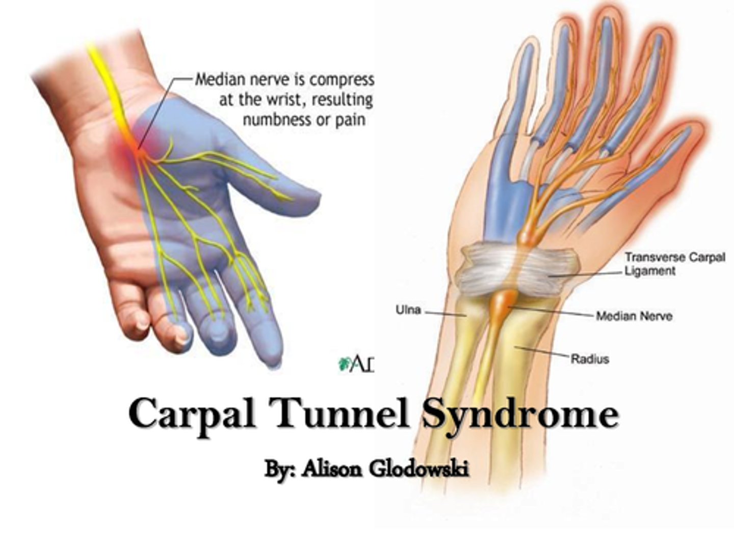 <p>What is carpal tunnel syndrome?</p><p>- entrapment of the median nerve in the carpal tunnel</p><p>- this leads to nerve compression</p><p>Symptoms?</p><p>- paresthesias, pain, and numbness in the distribution of the median nerve</p><p>- note that the thenar eminence atrophies but sensation is spared, because the palmar cutaneous branch enters the hand external to the carpal tunnel</p><p>What diseases is it associated with?</p><p>- pregnancy</p><p>- RA</p><p>- hypothyroidism</p><p>- diabetes</p><p>- dialysis related amyloidosis</p><p>- also, repetitive use</p>