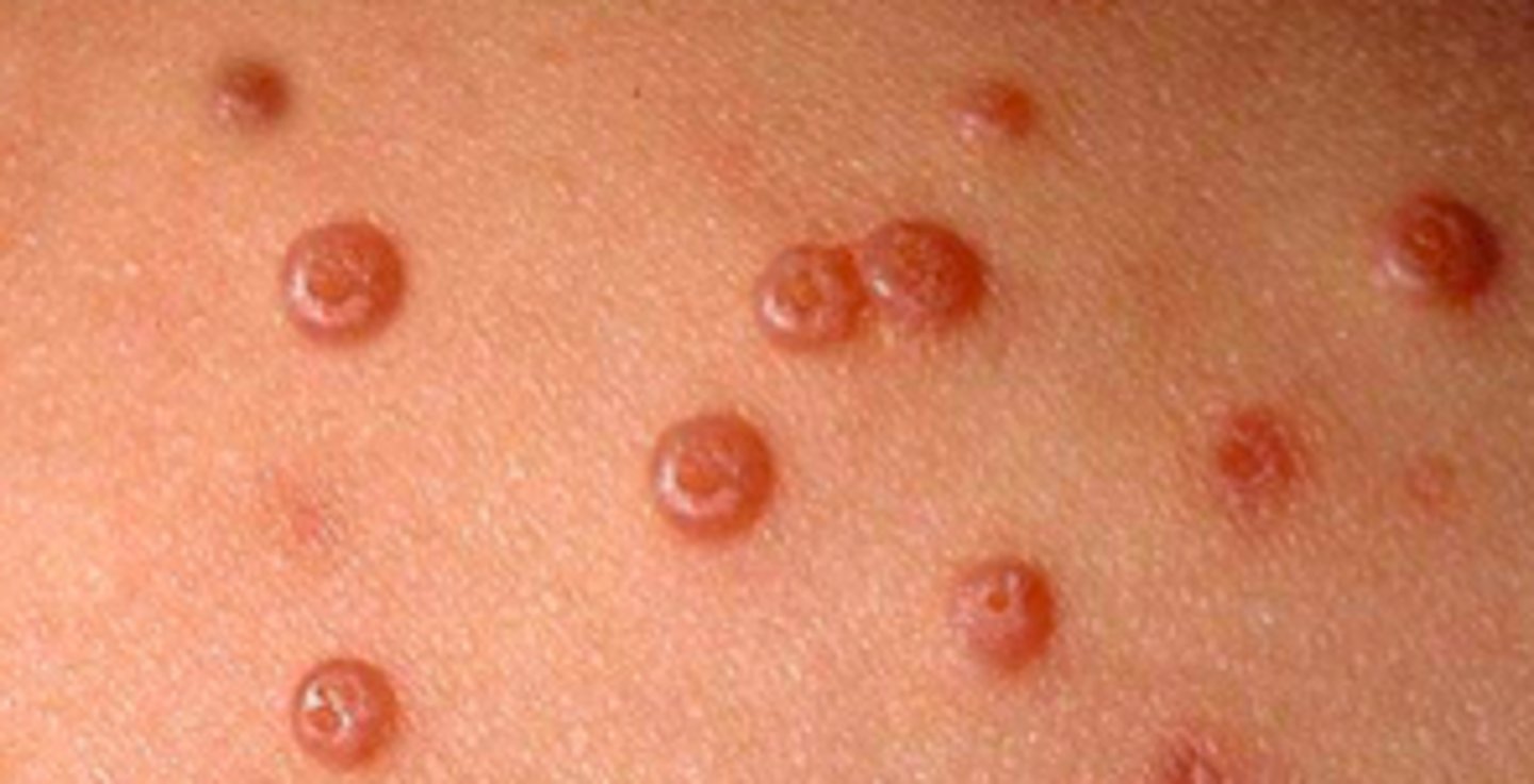 <p>Viral ID:</p><p>Objective:</p><p>Lesions:</p><p>- Firm, dome-shaped papules on skin</p><p>- Shiny surface and central indentation or umbilication</p><p>- Occasionally, growths can be polypoid with stalk-like base</p><p>- Appear anywhere on body except palms and soles</p><p>- Most common areas: trunk, axillae, antecubital, popliteal fossa, crural folds</p><p>- Lesions on eyelid can cause conjunctivitis</p><p>- Oral mucosal involvement is rare</p><p>- Lesions can be large and widespread (aka giant molluscum) in immunocompromised patients</p>
