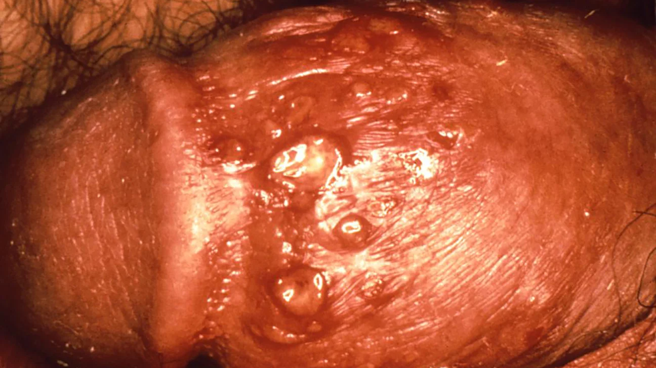 <p>= an STI (initial infection lasts 7 to 10 days, then remains dormant indefinitely) where clusters of small vesicles with surrounding erythema erupt on the glans, foreskin, or anus</p>