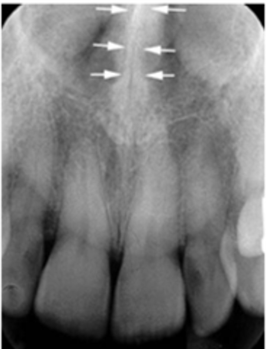 <p>radiopaque; between the nasal fossae</p>