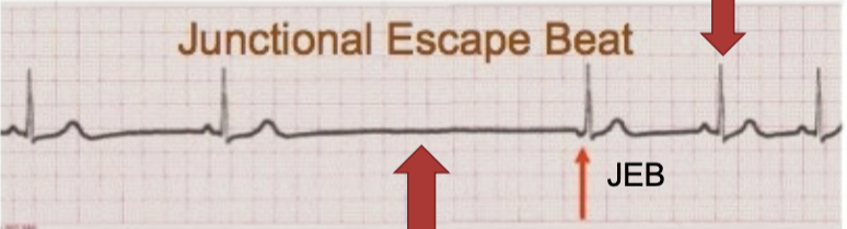 <p>late in the cardiac cycle -where next R wave should’ve been; no P, inverted P, or post-QRS P wave</p>