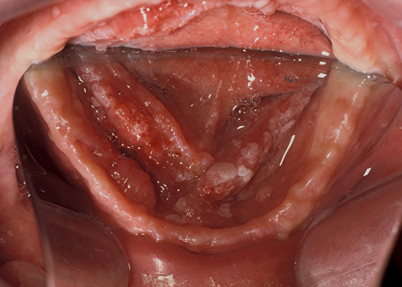 <p>Case 5. A 70-year-old smoker presents with an erythroleukoplaic lesion on the floor of the mouth for 6 months. He complains of pain and is unable to wear his denture. 5a. What is the most likely diagnosis?</p>