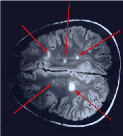 <p>This scan shows what disease</p>