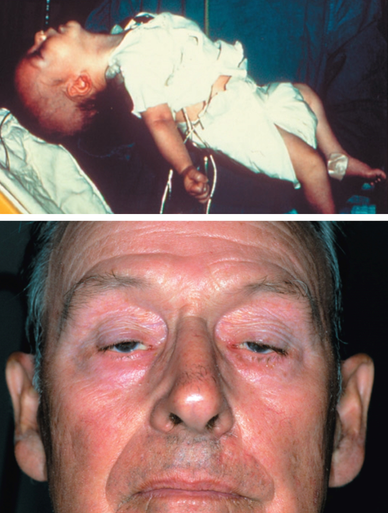 <p><span><span>Agent: Clostridium botulinum</span></span></p><p><span style="background-color: transparent;"><span>Toxin blocks the nerve signal that tells the muscle to contract </span><strong><span>(acetylcholine)</span></strong></span></p><p><br></p>