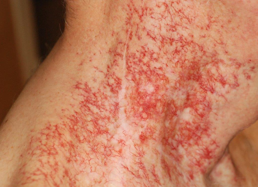 <p>skin becomes <strong>thick </strong>and <strong>leathery </strong></p>