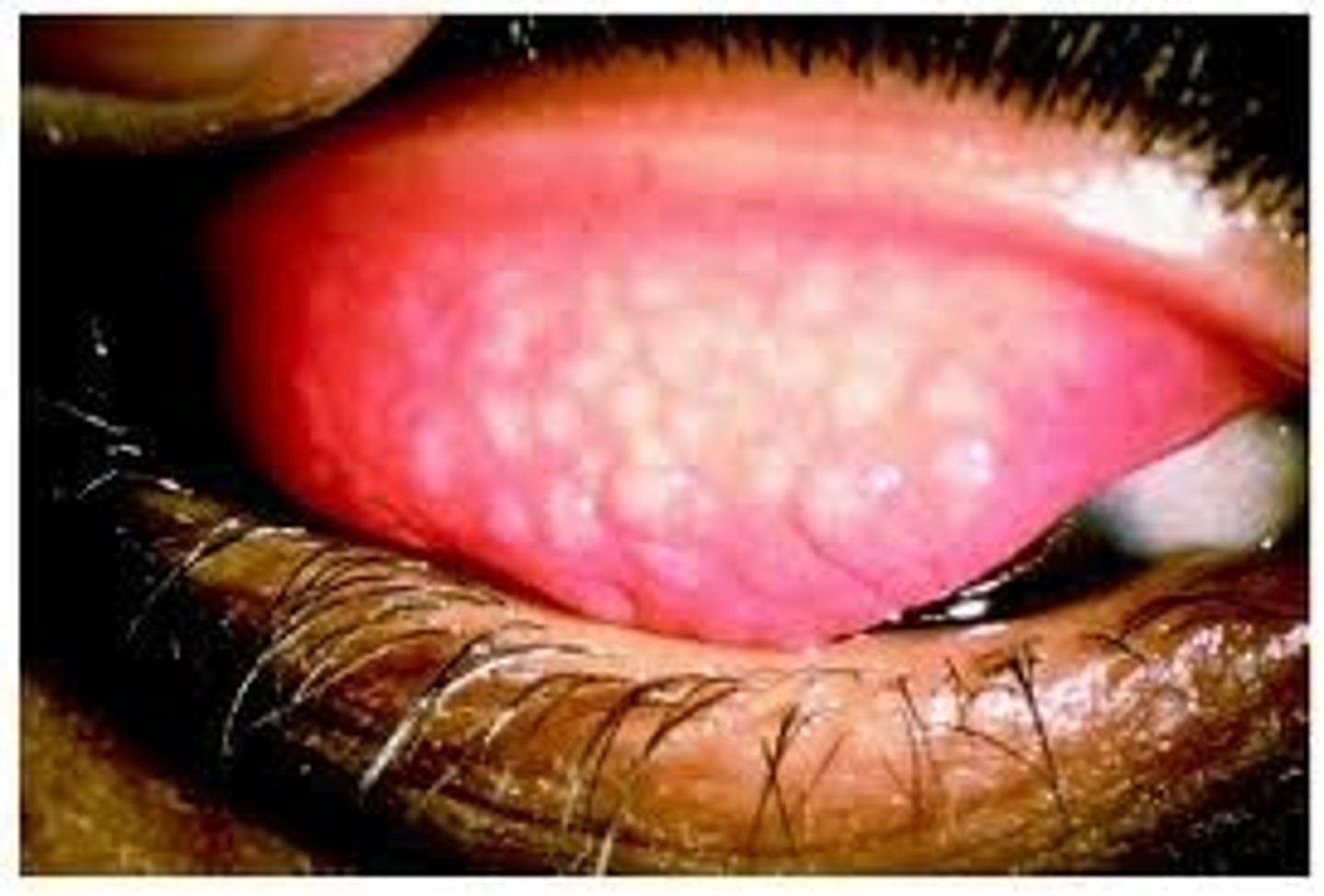 <p>Trachoma is a bacterial infection that affects your eyes</p><p>It's contagious, spreading through contact with the eyes, nose, or throat secretions of infected people, and handkerchiefs</p><p>Trachoma is the leading preventable cause of blindness worldwide.</p><p>Most blinding trachoma occurs in poor areas of Africa.</p>