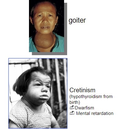 <p>too little TSH</p><p>or, other thyroid dysfunction</p><ul><li><p>thyroid gland failure (primary hypothyroidism)</p></li><li><p>deficiency of tropic hormones (secondary)</p></li><li><p>Symptoms:</p><ul><li><p>Reduced metabolic rate</p></li><li><p>cold intolerance</p></li><li><p>weight gain</p></li><li><p>reduced cardiac output</p></li><li><p>lethargy (fatigue)</p></li><li><p>Edema</p></li></ul></li></ul>