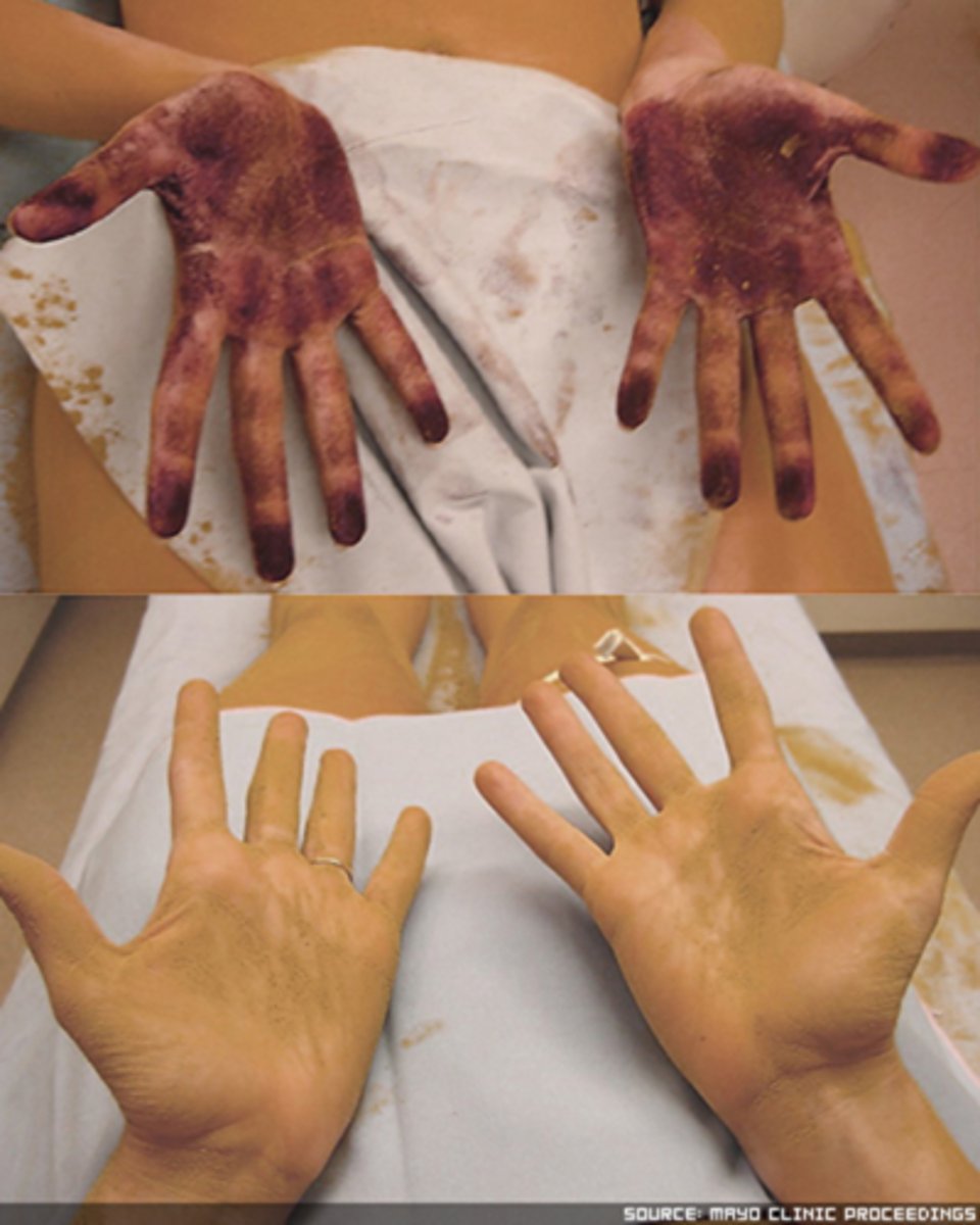 <p>exercise = one side of the face sweats while the other does not</p><p>skin temp = temp increases on the side that doesn't sweat</p><p>Quinizarin powder = purple colour indicates sweat is present (can be done colourless with corn starch)</p>