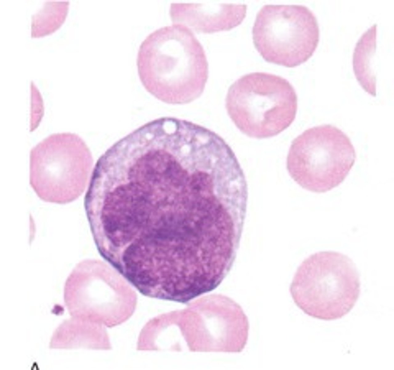 <p>irregular nucleus indented nucleus, coarser look, may have vacuoles or azurophilic granules</p>