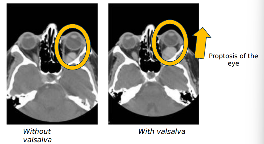 <ol><li><p>intermittent bulging of eyes on command or w valsalva maneuver </p></li></ol><p></p>