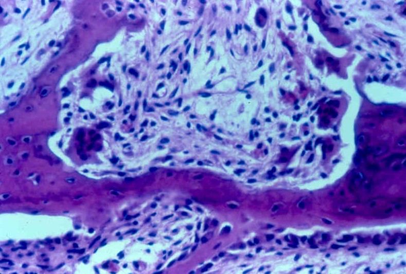 <p>What disease makes bone too pourous</p>