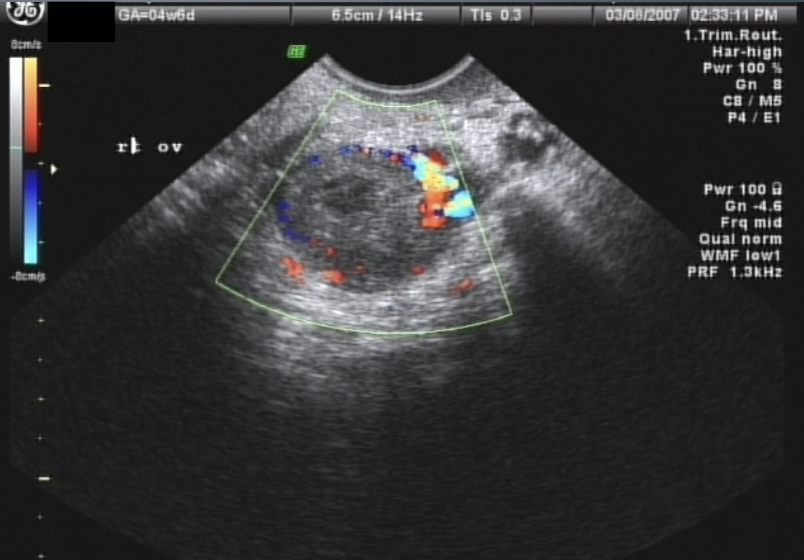 <ul><li><p>pain</p></li><li><p>nausea</p></li><li><p>vomiting</p></li><li><p>enlarged, tender ovary</p></li></ul><p></p>