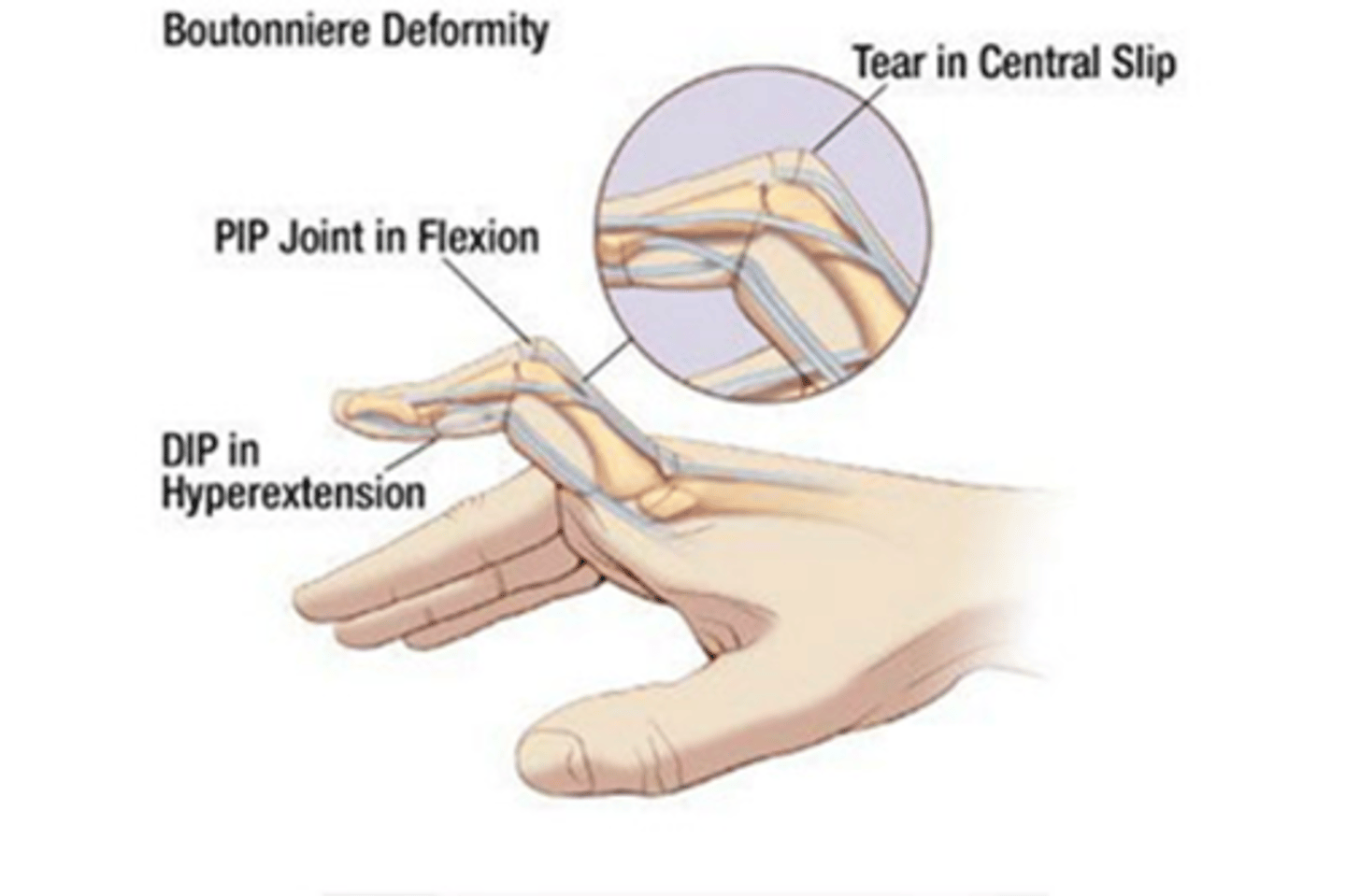 <p>flexion at PIP and hyperextension at DIP</p>