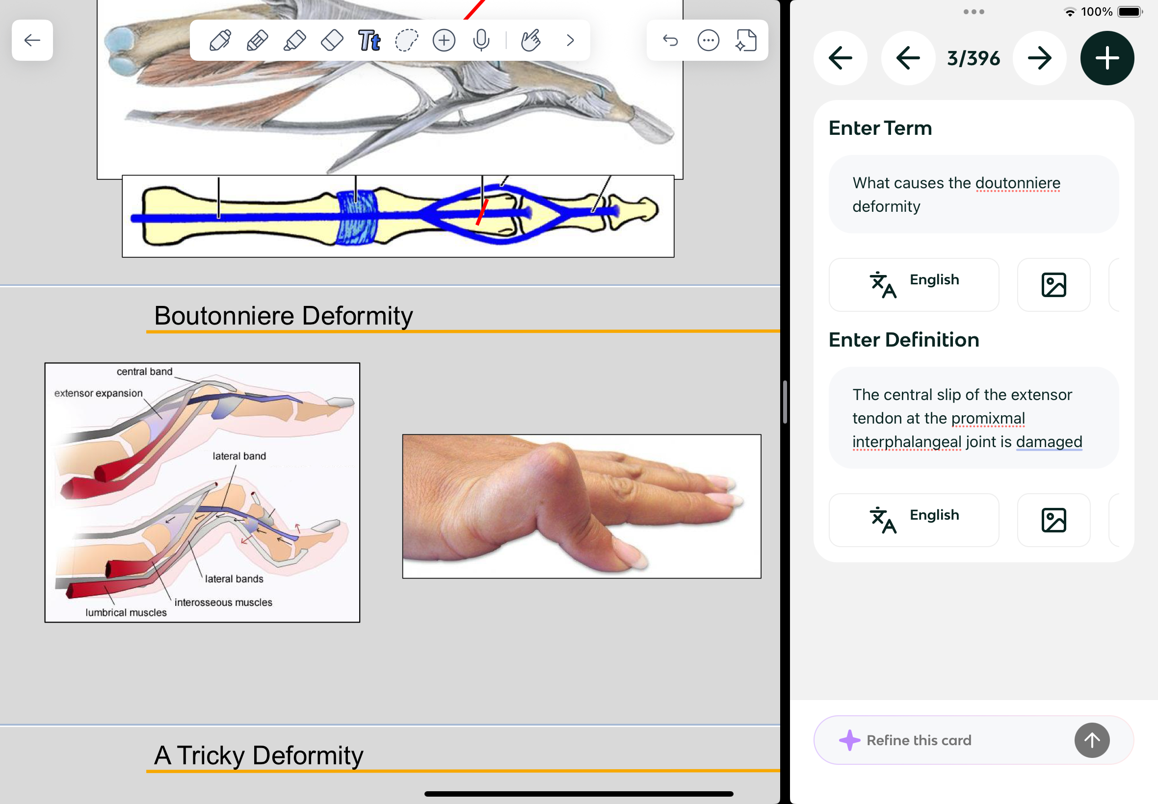 <p>The central slip of the extensor tendon at the promixmal interphalangeal joint is damaged </p>