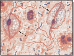 <p>is a sexually transmitted protozoal disease affecting both men and women. The disease is usually symptomatic in women, causing vaginitis with a profuse, thin, foamy, malodorous, greenish-yellowish discharge.</p><p>Patient Care. Use Standard Precaution</p><p>is caused by <mark data-color="yellow">Trichomonas vaginalis,</mark> a flagellate and is transmitted by direct contact with vaginal and urethral discharges of infected people</p>