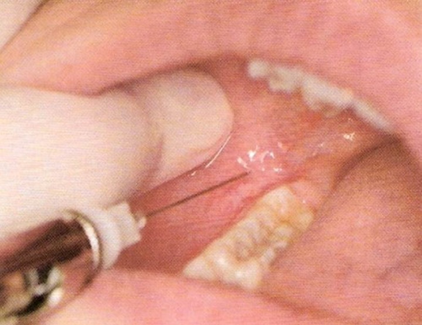 <p>the buccal fat pad, just distal and buckle to the terminal molar</p>