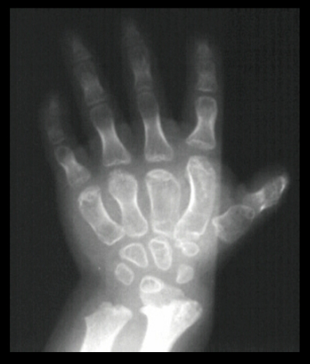 <p>Brachydactyly in humans.</p><p>-50%-80% of people with dominant allele show trait</p><p>-genes that give susceptibility for cancer have low penetrance</p>