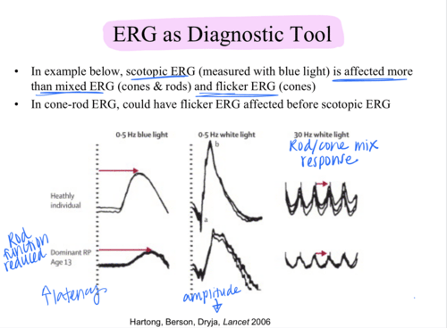 <p>In retinitis pigmentosa, which will be affected more?</p><p>Scotopic ERG/mixed ERG (cones and rods), flicker ERG</p>