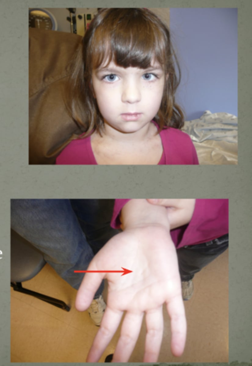 <p>Gorlin Syndrome</p>