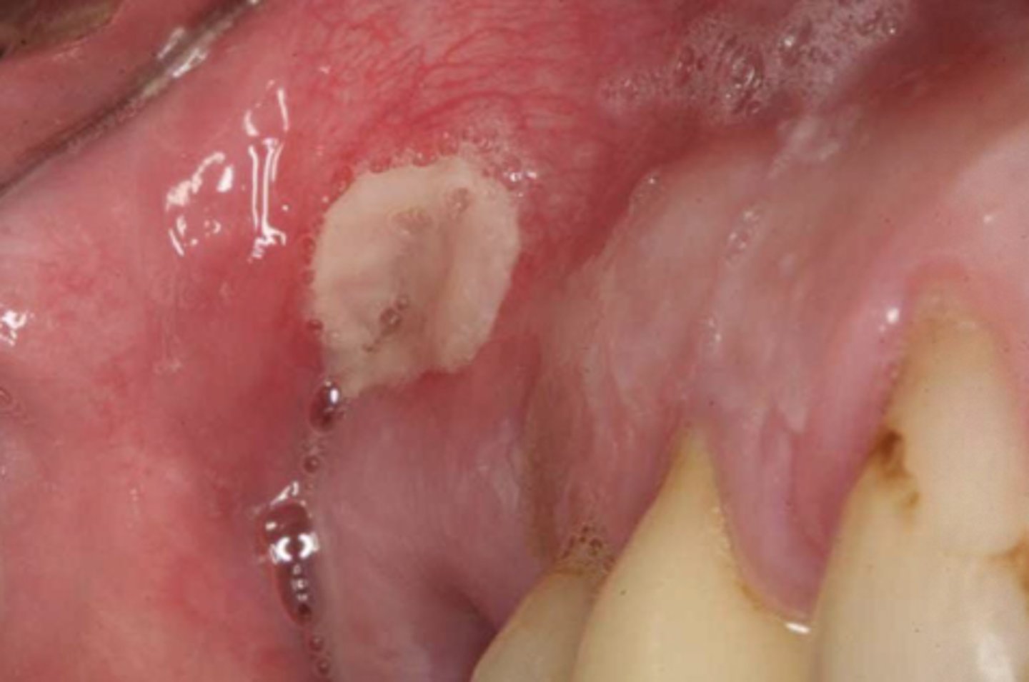 <p>Nicotine interferes with fibroblast differentiation and maturation</p><p>- nicotine and flavor chemicals in the e-cig vapr prevent fibroblast cells from getting the energy needed to heal a wound properly</p>