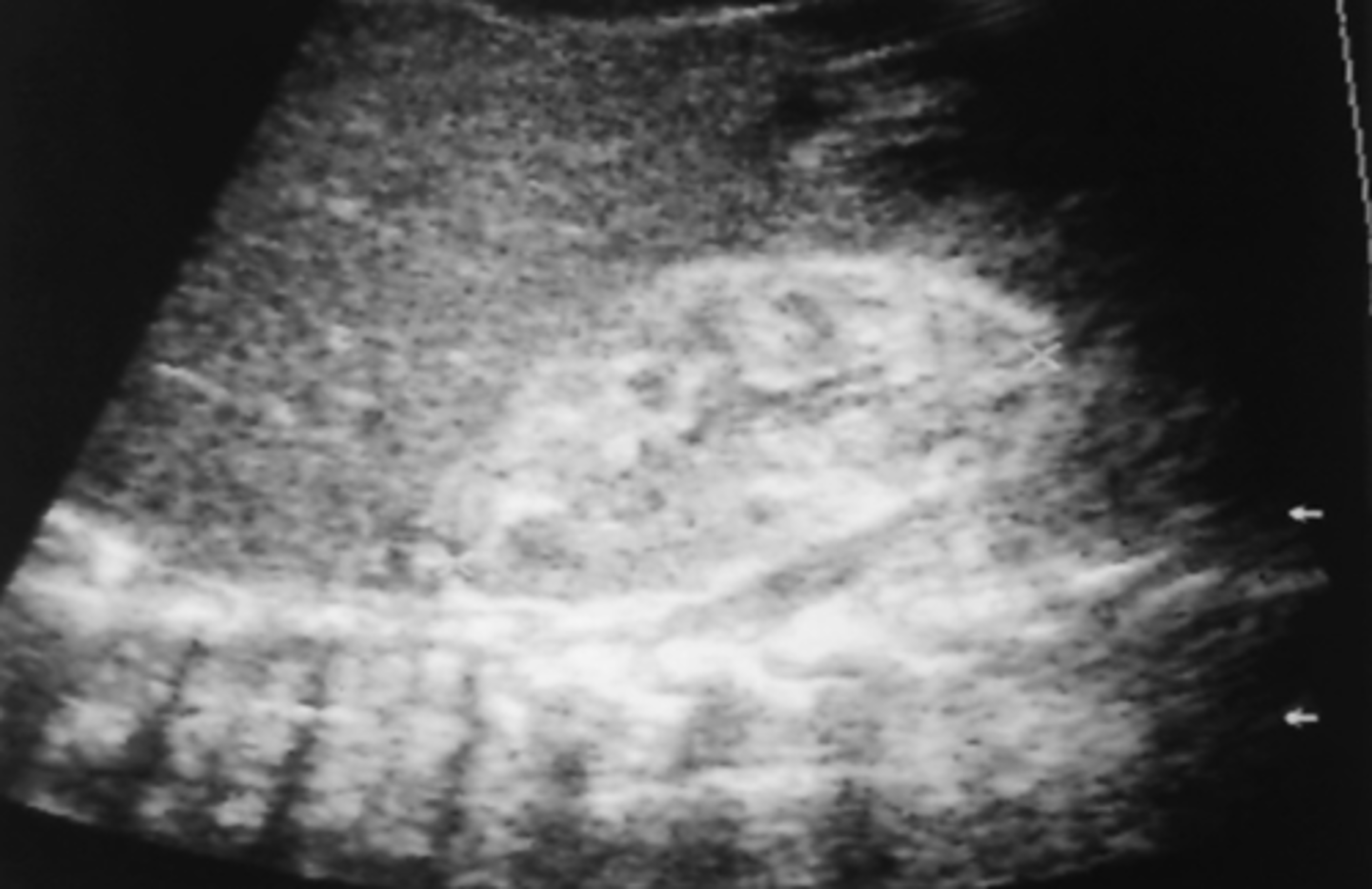 <p>-increased cortical echogenicity</p><p>-renal atrophy</p>