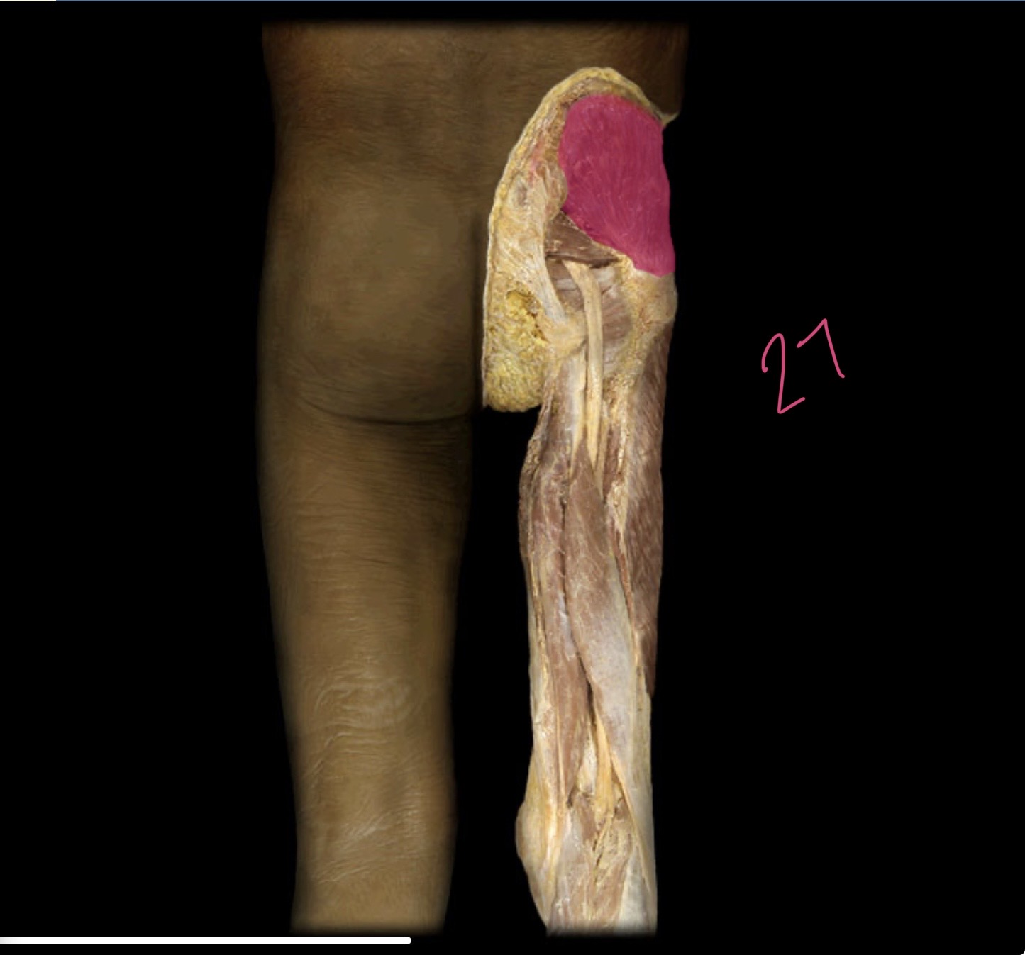 <p>Gluteus medius</p>