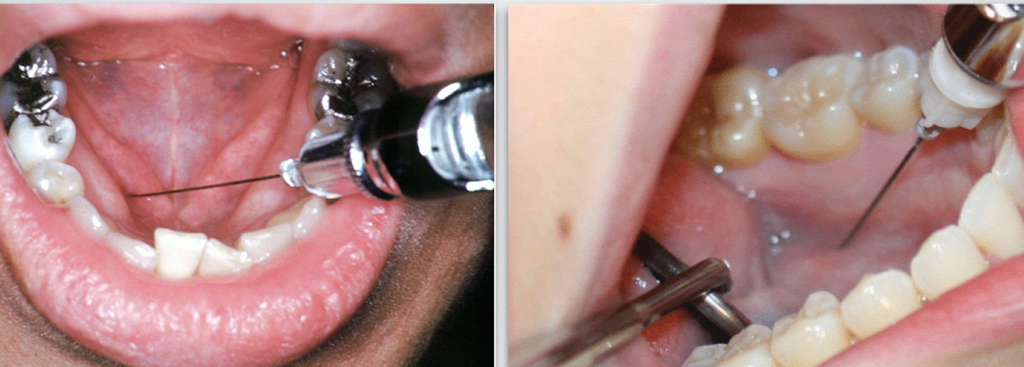 <ul><li><p>Use 25 gauge long needle</p></li><li><p>Retract the tongue</p></li><li><p>Direct the syringe from the opposite side</p></li><li><p>Direct needle tip to the apical region of the tooth immediately posterior to the tooth in question, until bone is contacted</p></li><li><p>Aspirate and deposit ~0.6 ml of solution</p></li></ul><p></p>
