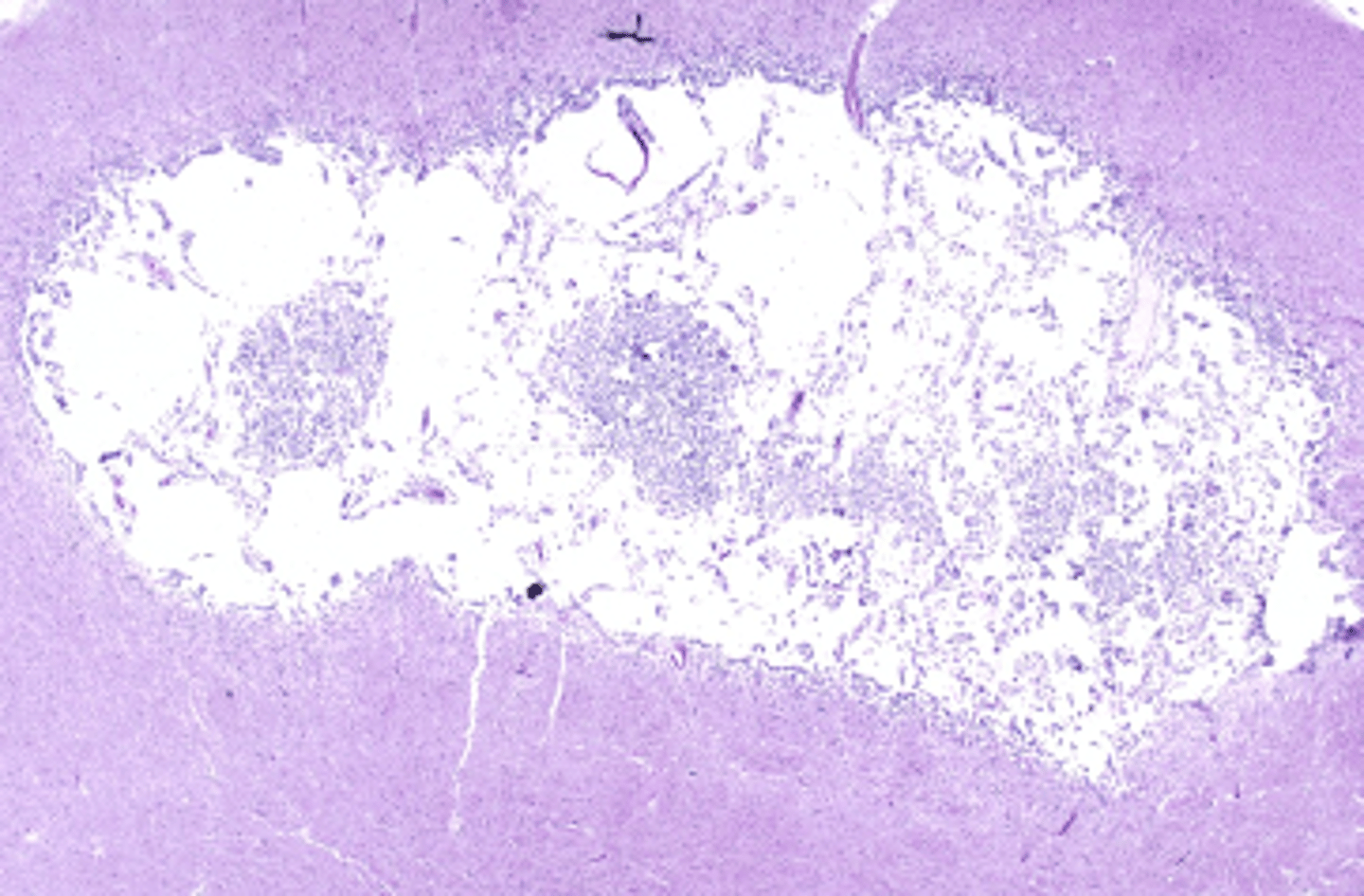 <p>What type of necrosis is being shown in this photo?</p>
