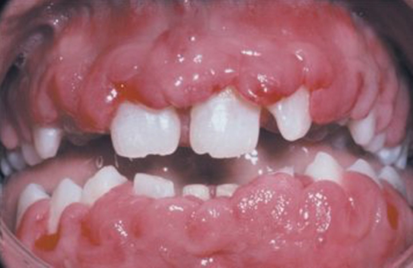<p>• May be hereditary</p><p>• May be medication related</p><p>• Dilantin (Phenytoin)</p><p>• Cyclosporine</p><p>• Nifedipine</p>