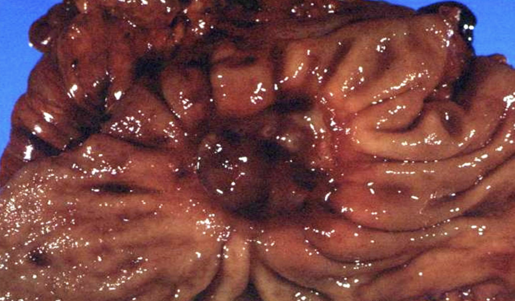 <p>Ulcerative inflammation</p>