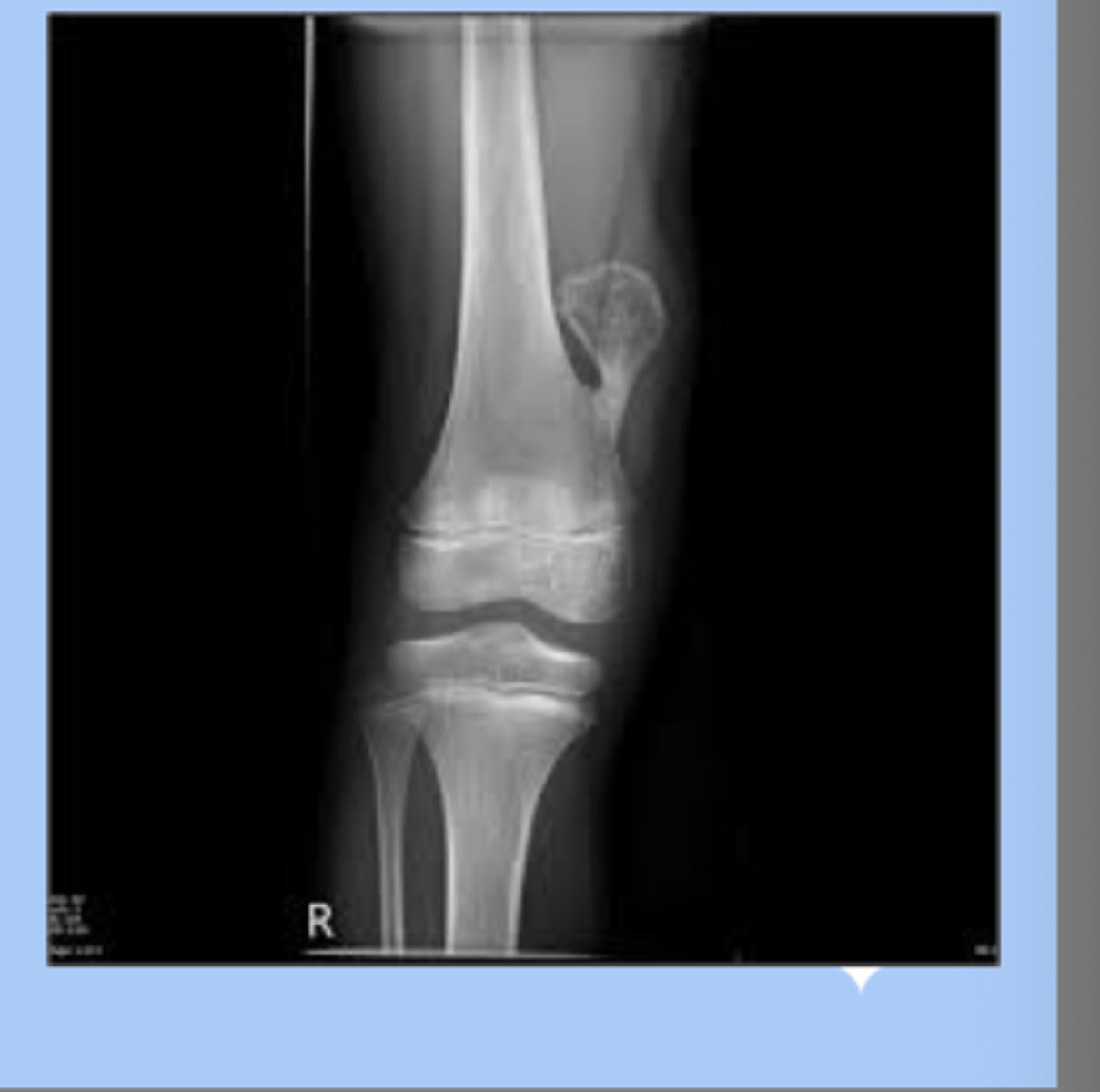 <p>-most common benign tumor in children </p><p>-males</p><p>-lesion is a bone mass capped with cartilage, grow in porportion to childs growth </p><p>sx: pain free mass</p><p>-dx: radiograph metaphyseal region </p><p>-tx: excision if interferes with function </p>