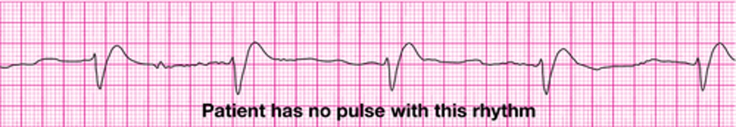 <p>Pulseless electrical activity</p>