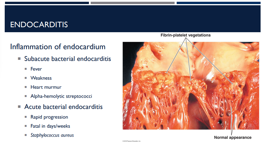 <p>The two major forms of endocarditis is Subacute bacterial endocarditis and Acute bacterial endocarditis. Describe acute bacterial endocarditis, especially the bacteria it is caused by. </p>