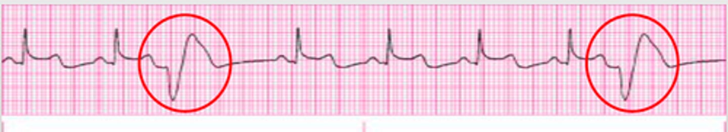 <p>Most common ectopic beats can occur with or without heart disease in any age group.</p><p>Causes: ischemia, hypokalemia, catecholamines.</p><p>Concern: frequent PVCs → ventricular tachycardia and VF.</p><p>Tx: treat cause and monitor.</p><p>PVCs + hypokalemia = replace potassium</p>