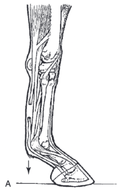 <ul><li><p><span>MCP/MTP joint is hyperextended (dropped) when limb is loaded</span></p></li></ul>