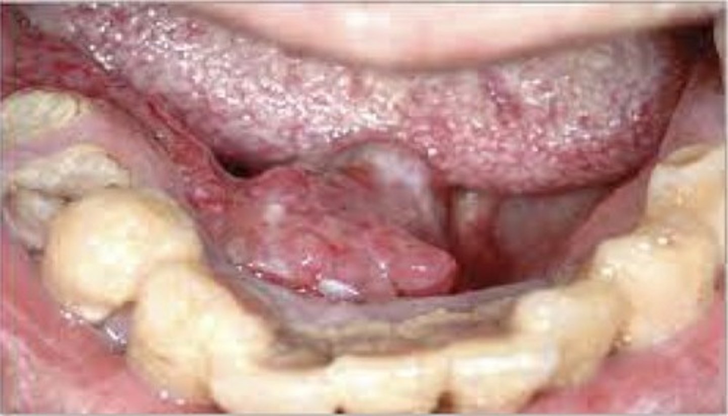 <p>A slow growing malignant tumour of either major or minor salivary gland tissue. May be ulcerated or painful. Most common site: parotid gland. Microscopic: encapsulated, infiltrates surrounding tissue. Small, deeply stinging, uniform epithelial cells that resemble "Swiss cheese". Tx: surgical excision.</p>