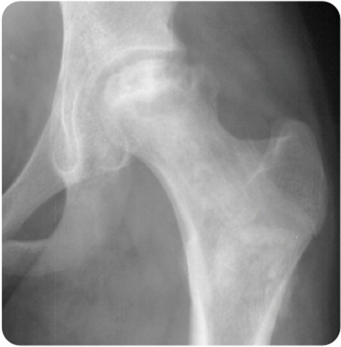 <p>A 17-year-old boy with a medical history significant for childhood leukemia that has been in remission for 2 years presents to the pediatrician’s office for evaluation of left hip pain. He describes the pain as constant, present at rest and at night, worse with activity, and radiating toward his groin. He states the symptoms have been ongoing for several weeks and have been steadily worsening. He is now having difficulty bearing weight on his left leg and walks with a limp. He has been taking over-the-counter ibuprofen with some relief but not a complete resolution of symptoms. He reports no specific injury or trauma, no associated fever or chills, and previous episodes of similar symptoms. He does not have radiating symptoms to his back, left knee, or right lower extremity. Vital signs are a temperature of 98.4°F, heart rate of 76 bpm, blood pressure of 116/74 mm Hg, respiratory rate of 12 breaths/min, and oxygen saturation of 99% on room air. On physical examination, he has pain with hip flexion past 90°, as well as painful and limited internal and external rotation when compared to the other side. Radiographs are shown above. What is the most likely etiology of his symptoms?</p><p>AChronic glucocorticoid use</p><p>BInfection</p><p>CObesity</p><p>DUntreated developmental dysplasia of the hip</p>