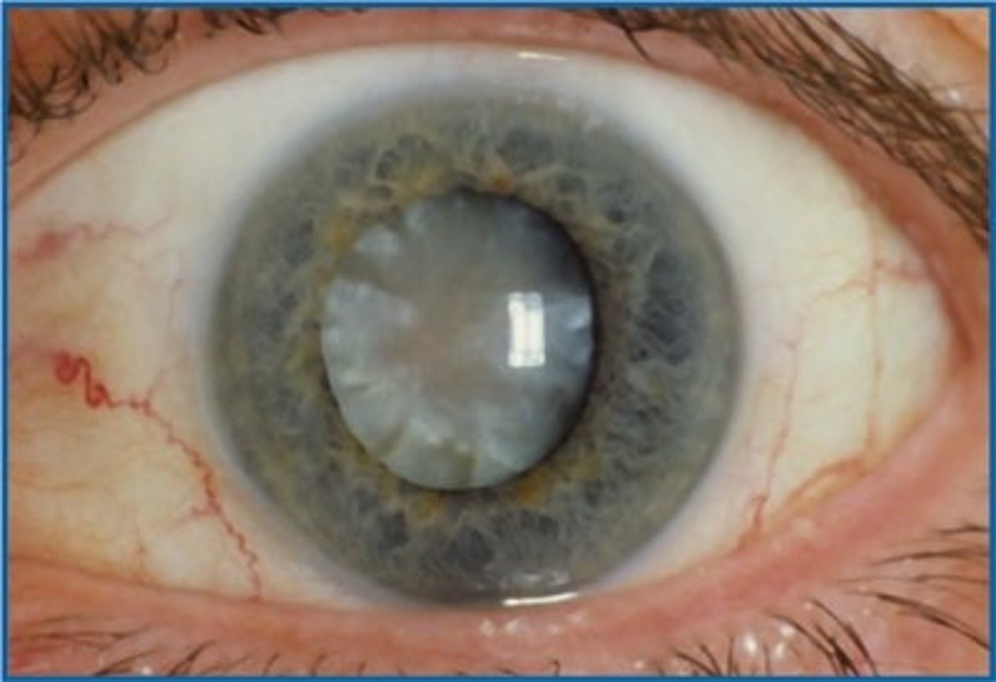 <p>1. Family history of cataracts</p><p>2. Steroid medication use</p><p>3. Exposure to ultraviolet light</p><p>4. Cigarette smoking</p><p>5. Diabetes mellitus</p><p>6. Aging</p>
