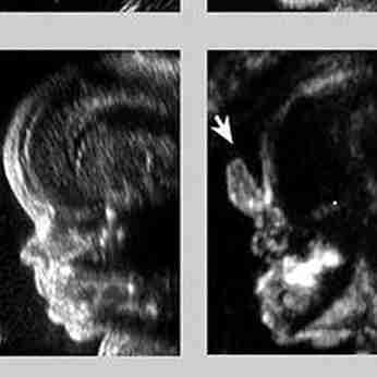 <p>Proboscis and arhinia are associated with holoprosencephaly</p><p>Turricephaly, due to early closure of the coronal suture, is typical of Apert syndrome (acrocephalosyndactyly)</p>