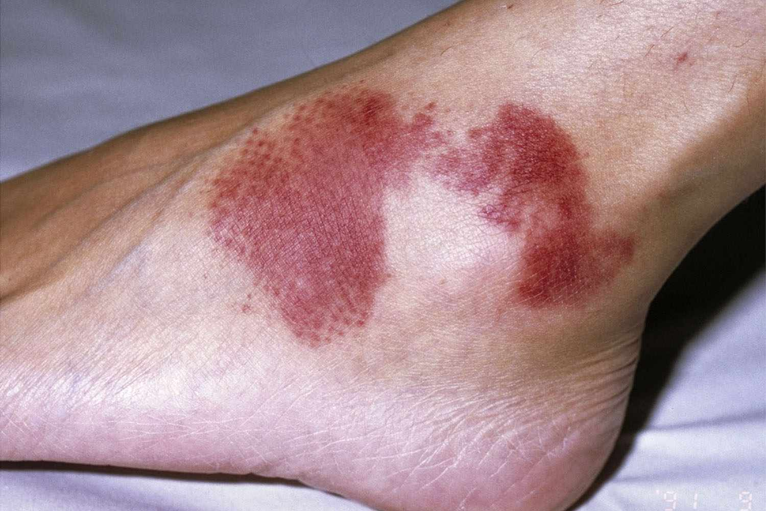 <p>Blood discoloration</p>