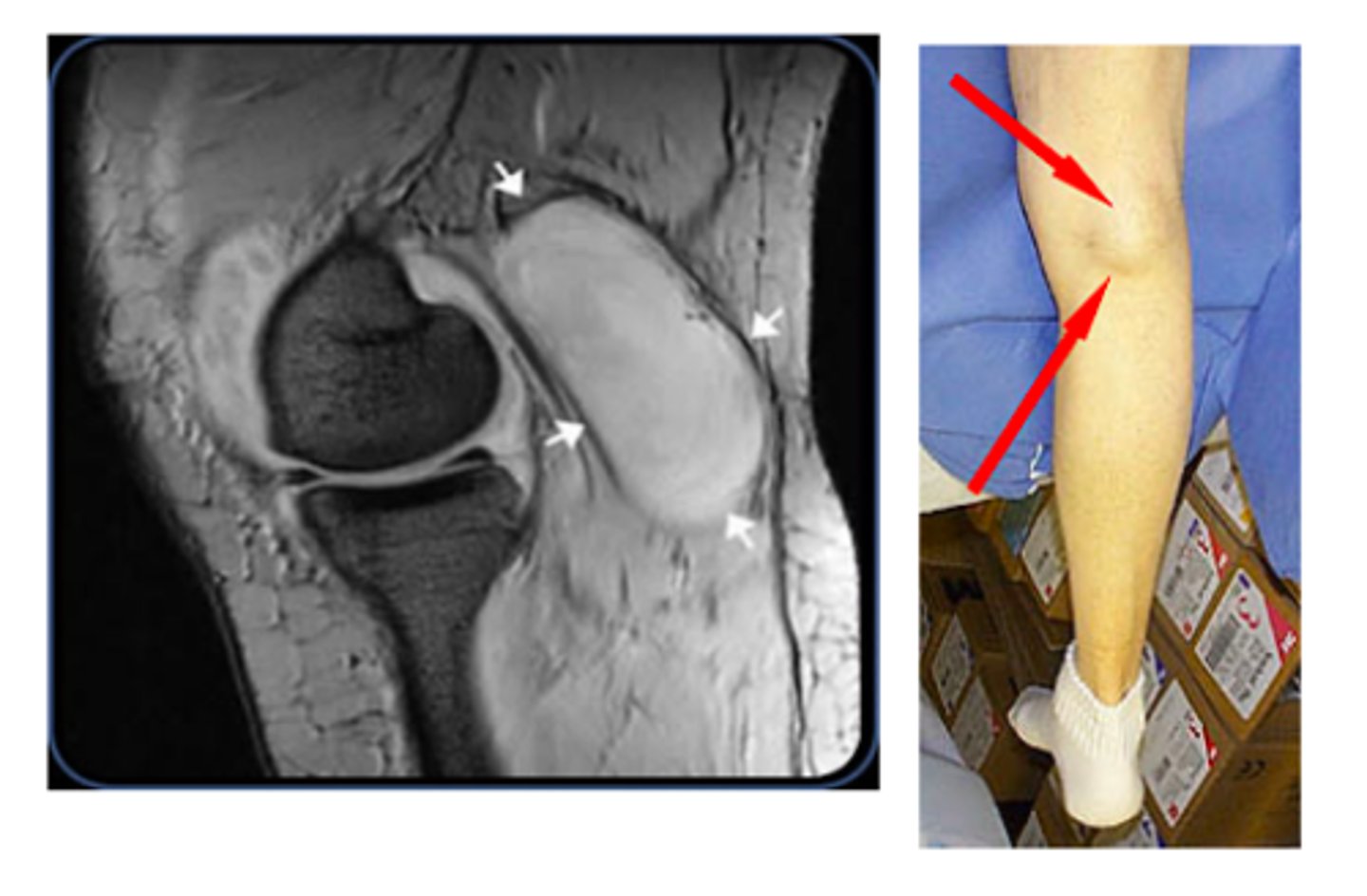 <p>Yes - pain can be mistaken for DVT</p><p>- if it ruptures, it can result in severe calf pain (m/c in elderly)</p>