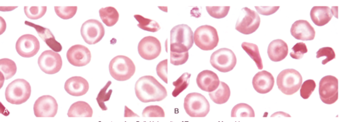 <p>- normochrom/normocyt anemia<br>- hgb 11-13 mg/dL<br>- retics</p>